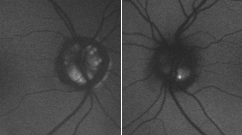 Fundus autofluorescence