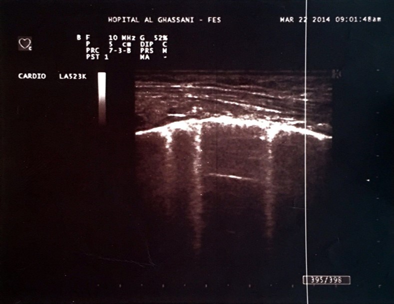 Hyperechoic microreflections indicating the presence of extravascular lung water known as B-lines in one of our patients.