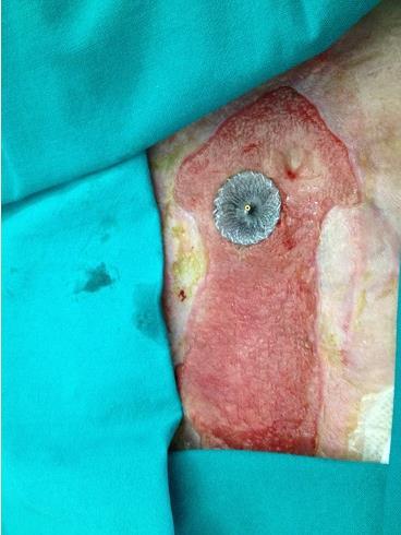 Enteroatmospheric fistula with cardiac septal occlude