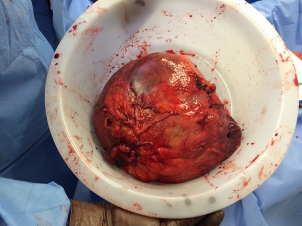 Spleen following removal – medial and hilar aspect shown.  Arrow points to area of rupture.