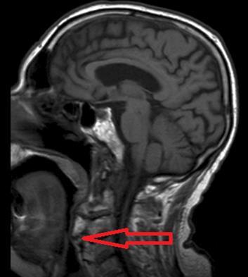 Osteophytes-induced upper airways obstruction