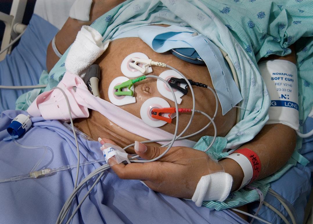 Patient with the uterine electromyography electrodes, the tocodynamometer transducer and the fetal heart rate Doppler applied to the abdomen.