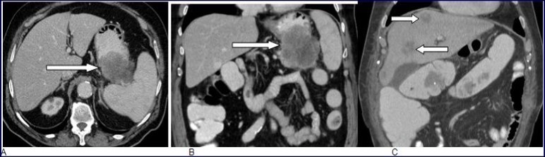 A and B, Abdominal CT scan with intravenous contrast enhancement showed a huge mass of the gastric body, largely necrotic, infiltrating the pancreatic tail, the spleen and the left transverse colon. CT scan did not reveal any other lesion except the gastric tumor. C: Multiples liver metastases two months after surgical operation.