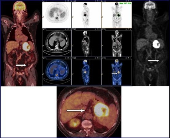 18F-FDG PET-CT with injection of intravenous iodinated contrast demonstrated an intense and diffuse hyper metabolism at the primary tumor of the stomach. No morphological or metabolic argument features of secondary manifestation of this tumor were observed in the whole-body.