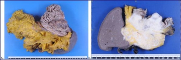 A-Macroscopic aspect: “En bloc” resection of stomach, spleen and omentum, with a part of pancreas and colon (not shown on this photograph). The stomach has been opened to show the tumor. B-Macroscopic aspect: Large tumor with macroscopic infiltration of stomach wall, omentum, pancreas and spleen.
