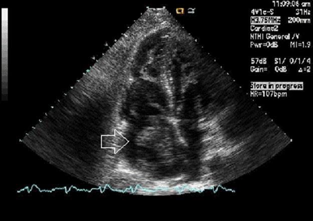 Echographic image of Case 1 of the large, mobile thrombus in the right atrial cavity.