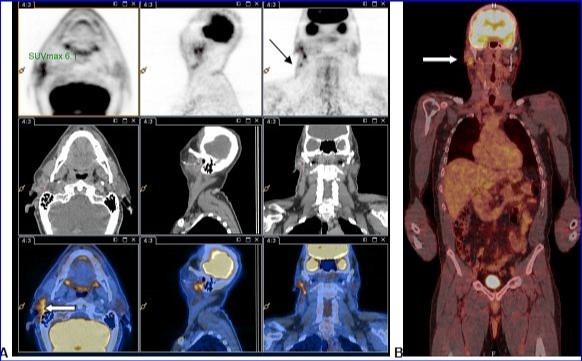 A and B: PET-CT with 18F-FDG injection of iodinated contrast showed: A.Intense and diffuse hyper metabolism at the surgical site in the right parotid (large white arrow) and discretely hypermetabolic lymph nodes in the ipsilateral lymph nodes areas II and III (thin black arrow).  B. Lack of morphological or metabolic arguments for primary or secondary manifestation of malignant melanoma of the others structures examined.