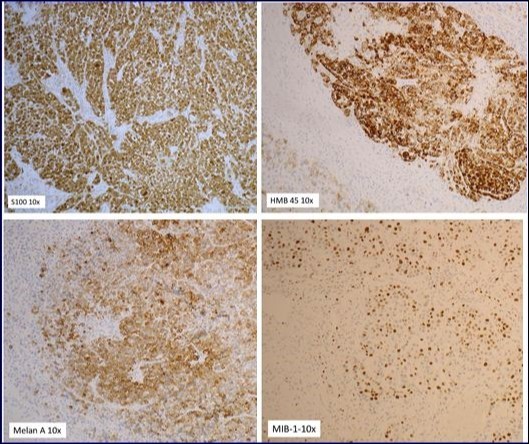The immunohistochemistry for both S100 and HMB 45 were positive 
establishing diagnosis of primary malignant melanoma of the parotid.
