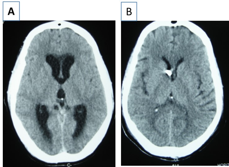 cerebral CT scan with axial view showing  acute hydrocephalus (A) and control after external ventricular drainage (B)