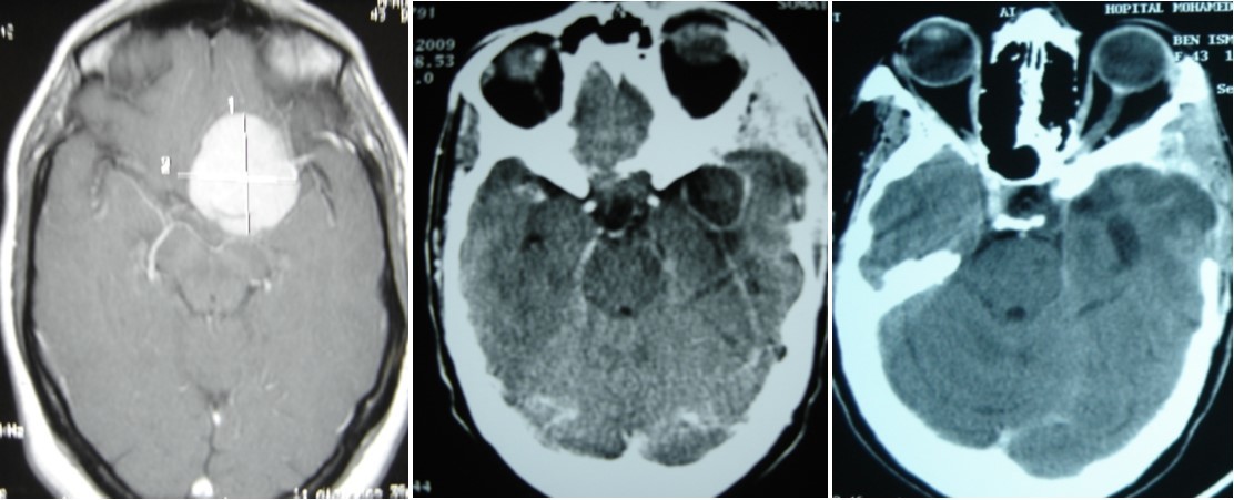 (A) pre operative MRI, axial T1 weighted with enhancement of sphenoid wing meningioma. (B) Ct scan showing an brain abscess in post op area. (C) CT scan after remoral sugery and 2 months medical treatment.
