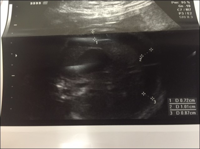 Antenatal Ultrasound demonstrating the guide wire and shunt in position. The thickness of the amniotic fluid is being measured by the markers.