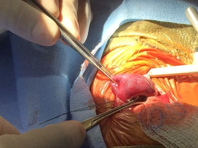 Post natal thoracotomy showing the CLM with a systemic blood supply being removed sucessfully.