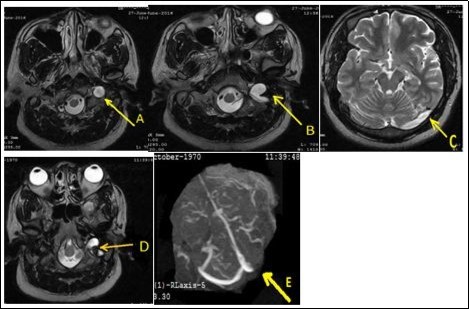 Thrombosis of the left internal jugular vein extended to the transverse sinus (A, B, C). After three months of anticoagulant therapy, it remains a partial thrombosis of the jugular vein (D) and complete thrombosis of the transverse sinus (E).