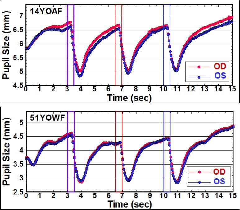 Pupillograms of two normal cases. The purple vertical lines indicate the 0.5 second period when the cartoon picture was shown to both eyes. The red and blue lines indicate the monocular illumination to right and left eye, respectively.