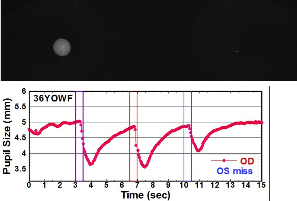 Pupillograms of a patient with +RAPD optical nerve damage
