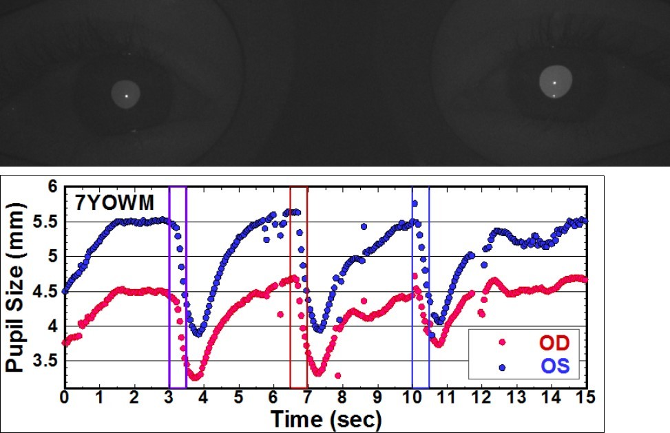 Pupillograms of a 7 years old boy with anisocoria