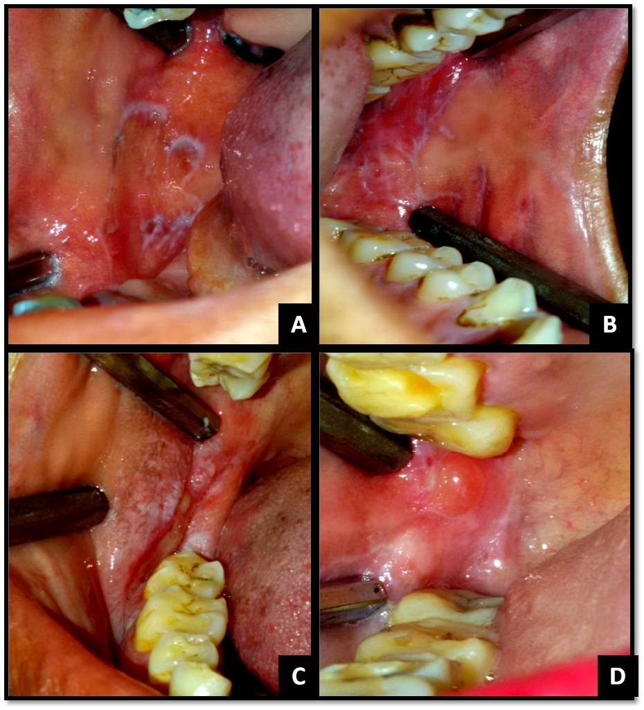 (A) Reticular OLP on right buccal mucosa; (B) Reticular OLP on left buccal mucosa; (C) Erosive and papular OLP on right buccal mucosa and vestibule; (D) Bullous OLP on right buccal mucosa;