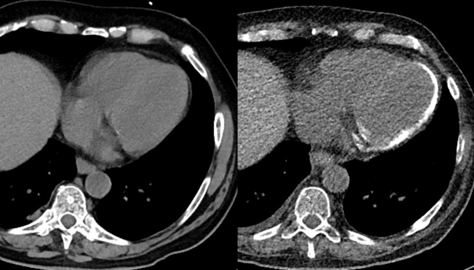 Non-contrast enhanced CT scans of the chest initially during onset of pneumogenic sepsis (right) and after 10 weeks (left) show rapid development of non-preexisting, extensive myocardial calcifications.