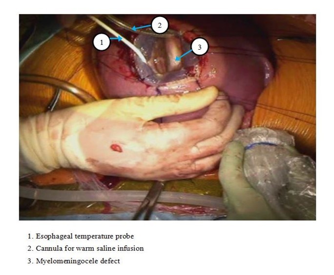 Exposure for Open Fetal Surgery for Myelomeningocele
