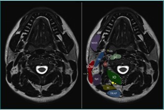 MRI anatomy of the upper cervical region. DI = digastric muscle; IO = inferior oblique muscle; LC = longus colli muscle; LE = levator scapulae muscle; MAS = masseter muscle; SC = semispinalis cervicis muscle; SCM = sternocleidomastoid muscle; SpC = splenius capitis muscle; TRAP = trapezius muscle; GA = great auricular nerve; GON = greater occipital nerve; GN = glossopharygeal nerve. LON = lesser occipital nerve; TON = third occipital nerve. Note the bifid spinous process of C2. (Image courtesy of Andrea Trescot, MD Clinical presentation