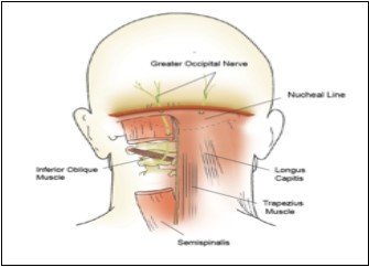Path of the greater occipital nerve. (Image courtesy of Epimed    International®, with permission)