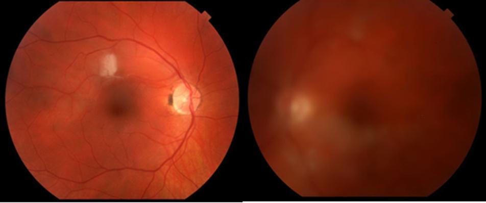 Fundus photos on first presentation showing a white lesion in the right eye while the left eye showed moderate vitritis with white lesions off the superior and inferior arcades.