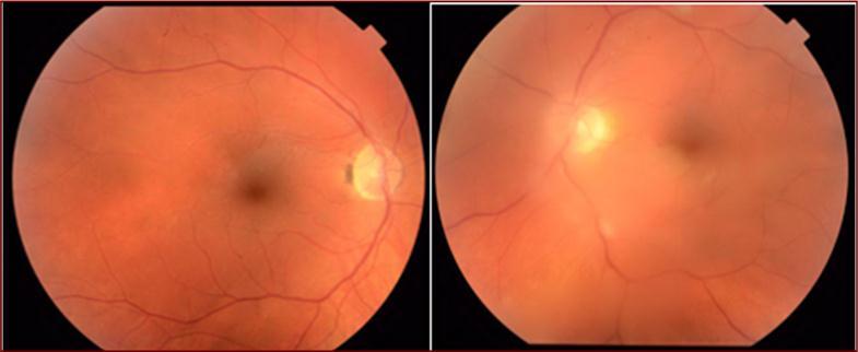 Fundus photos two months after first presentation showing resolution of the white lesion in the right eye and improvement of the vitritis in the left eye.