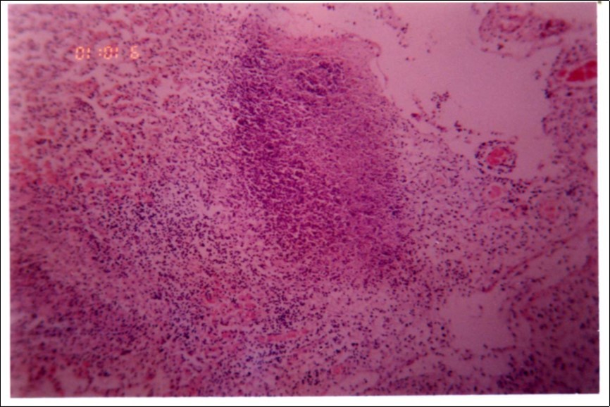 Extensive loss of air space due to necrosis and infiltration of neutrophils (H&E ×100).