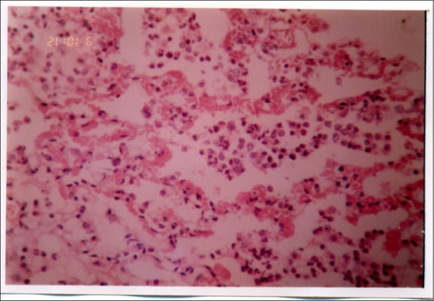 Hyperemia of alveolar wall capillaries, presence of few fibrin and neutrophils infiltration (H&E ×400).