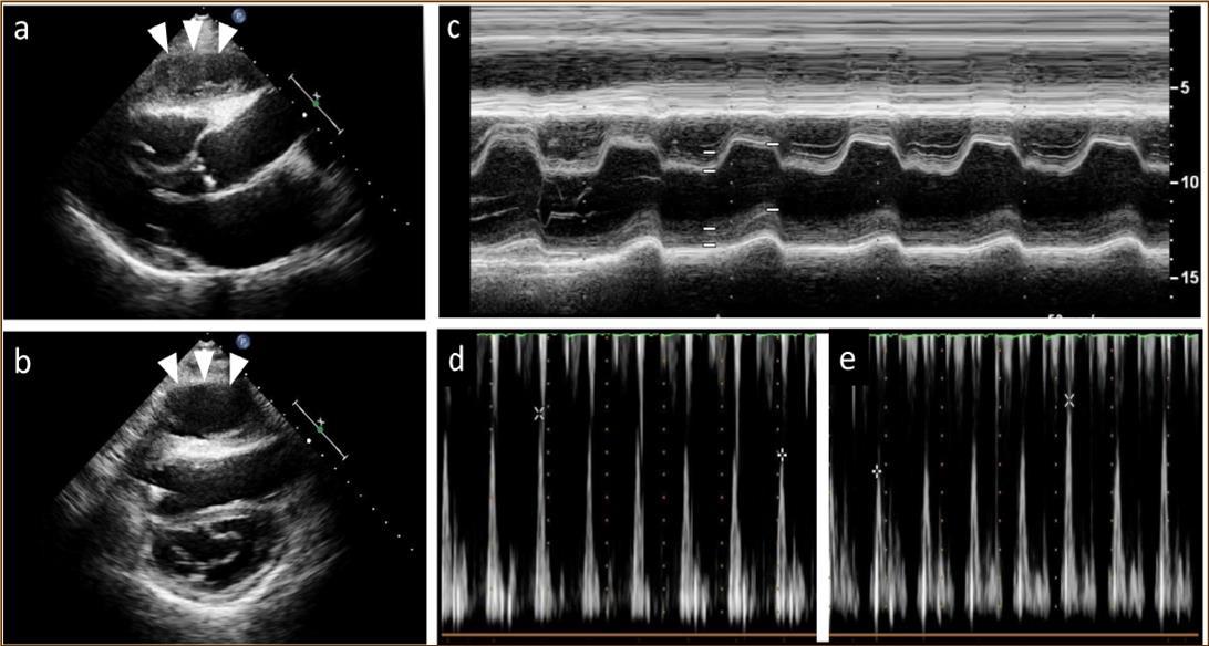 Echocardiography findings. A large cystic-like mass with a thick capsule was found in front of the the right ventricle (white arrows) (a. long axis view; b. short axis view). Paradoxical septal motion were seen in a motion mode image of left ventricle (c). Respiratory variation in both mitral (d) and tricuspid inflow velocities (e) were seen.