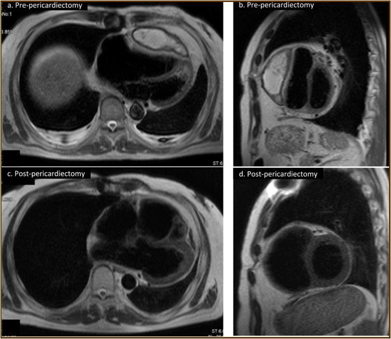 Magnetic resonance imaging findings. A thick cystic-like capsule which was tightly adhered to the right ventricle was seen (a. transverse view; b. sagittal view). A cystic-like capsule was removed after pericardiectomy (c. transverse view; d. sagittal view).