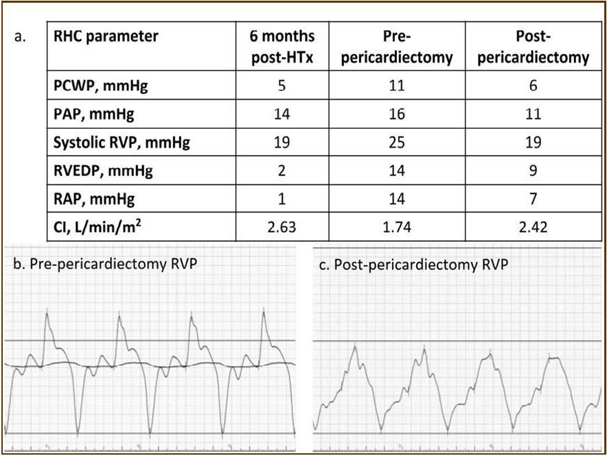 Hemodynamic parameters. Both right and left ventricular filling pressure (RAP, and PCWP) were upregulated and CI was reduced just before pericardiactomy. RAP, and PCWP were lowered, and CI was upregulated after pericardiectomy. The classic dip-and-plateau pattern of right ventricular diastolic pressure was observed (b). CI, cardiac index; HTx, heart transplantation; PAP, pulmonary artery pressure; PCWP, pulmonary capillary wedge pressure; RAP, right atrial pressure; RHC, right heart catheterization; RVEDP, eight ventricular end-diastolic pressure; RVP, right ventricular pressure.