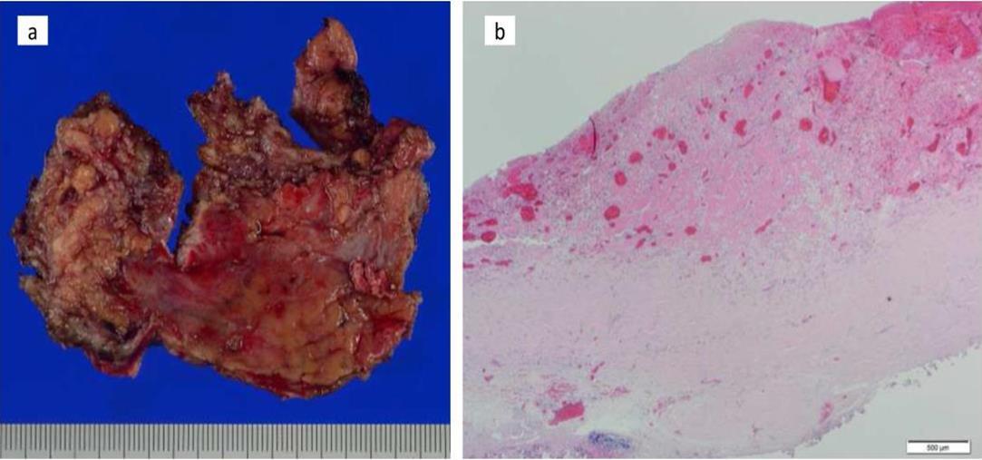Pathology findings. Chronic fibrosis and chronic inflammation with plasma cells were seen, but no infectious etiology was identified in resected tissues (a. macroscopic; b. microscopic)