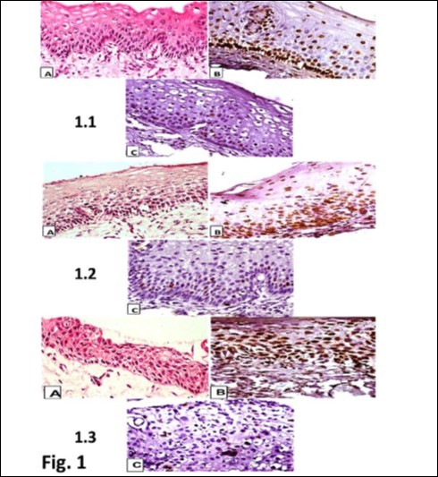 Photomicrographs showing (a. x 100) Hematoxylin and Eosin (H&E) and immunohistochemical staining of (b. x 400) p16INK4a and (c. x 400) Ki-67.  1.1. CIN I, a, H&E staining. b, diffuse (one-third) p16INK4a immunostaining. c, scattered Ki-67 immunostaining in CIN 1;  1.2. CIN 2. a, H&E staining. b, diffuse nuclear and cytoplasmic (two-third) p16INK4a immunostaining. c, scattered Ki-67 immunostaining in CIN 2;  1.3. CIN 3. a, H&E staining. b, diffuse nuclear and cytoplasmic (above two-third) p16INK4a immunostaining. c, scattered Ki-67 immunostaining in CIN 3.