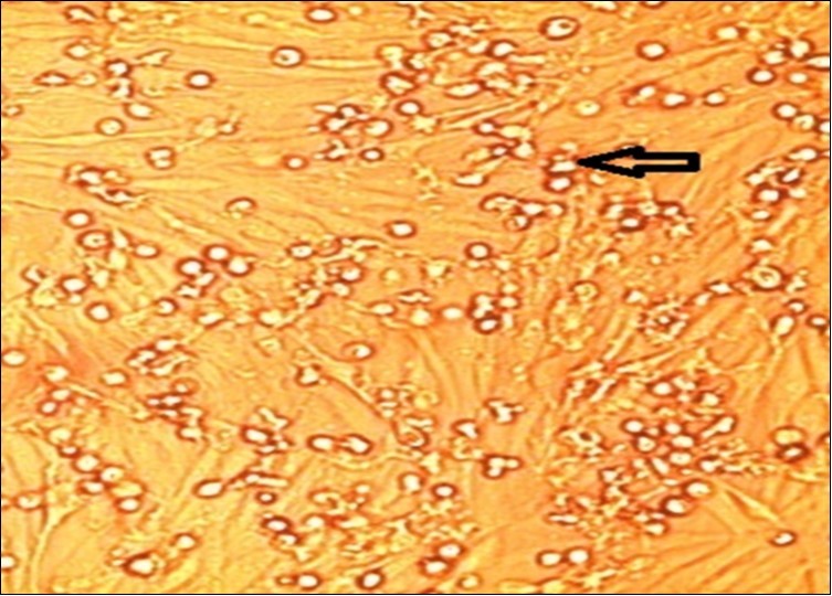 FMDV infected BHK-21 cells culture and Cyto-Pathic Effect (CPE) in the form of cells rounding and detachment, granularity of the cytoplasm and complete cell lysis.