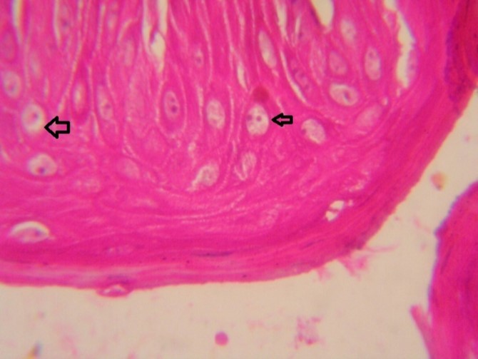 Tongue (dead cattle less than 1 year old) showed vesicular nuclei of stratum corium epithelium which suffering hydropic degeneration. Esinophlic intranuclear inclusions were seen surrounded by hallow zone(arrows).  (Hematoxylin and fuchsin X 60)