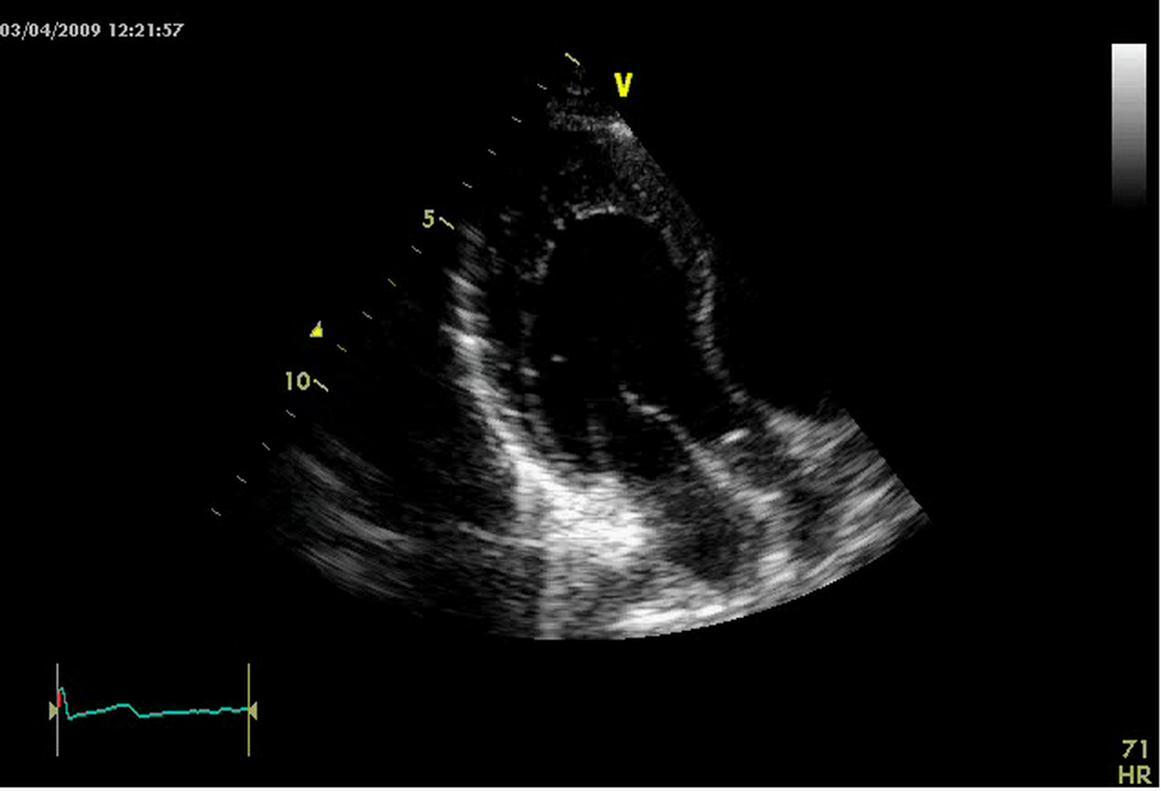 Echo image focused on infero-lateral apical segment of left ventricle