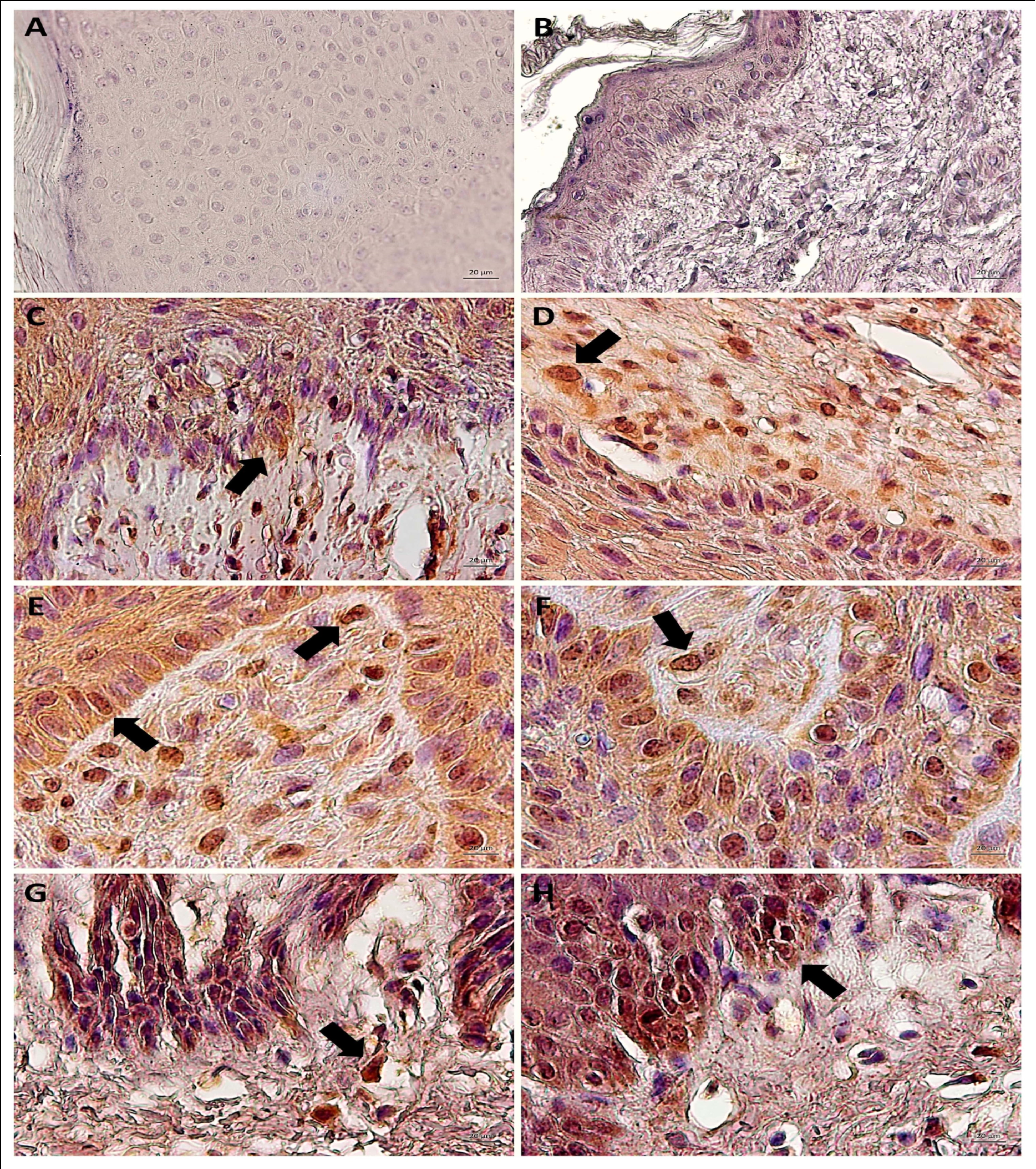 Immunodetection of STAT3 Y705 (active) showing the absence of expression in negative control  (A, cutaneous papilloma incubated exclusively with secondary antibody) and BPV-free normal skin (B). Results show the aberrant nuclear immunodetection of STAT3 Y705 cutaneous papilloma (C and D, papilloma 01),  fibropapilloma (E and F - papilloma 02 and 03, respectively) and esophageal carcinoma (G and H). The STAT3 Y705 expression was verified in keratinocyte-like cells present into the dermis. Images obtained using objectives of 10X (A, B, C and G) and 20X (D, E, F and H).