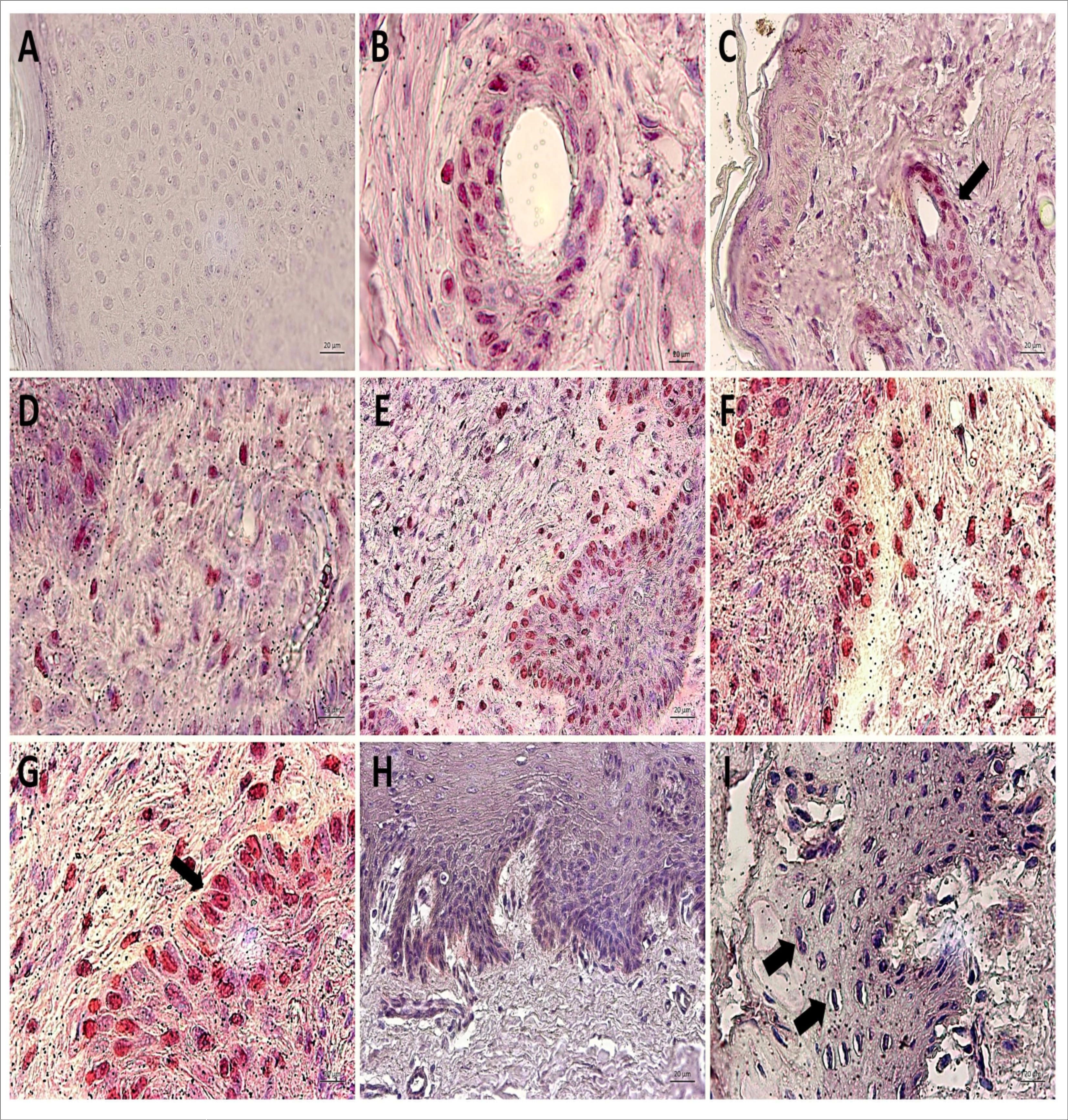 Immunodetection of Oct-3/4 showing the absence of expression of this nuclear transcription factor in negative control (A, cutaneous papilloma incubated exclusively with secondary antibody) and the Oct-3/4 expression restricted to cells of hair follicle (pointed by the arrow) and some basal keratinocytes of BPV-free normal skin, as expected (B and C). However, the results show an aberrant nuclear immunodetection of   Oct-3/4 in both epidermis and dermis of cutaneous papilloma, including in depolarized basal keratinocytes (arrow) (D, papilloma 01) and fibropapilloma (E – papilloma 02 and  F-G – papilloma 03). It was not verified the Oct-3/4 expression in esophageal carcinoma (H and I). This  result can be attributed to the high mitogenic  activity  observed in this tissue, which was verified by the presence of mitotic cells  (arrow) (I). Images  obtained using objectives of 5X (C, E and H), 10X (A, D, F and I) and 20X (B and G).