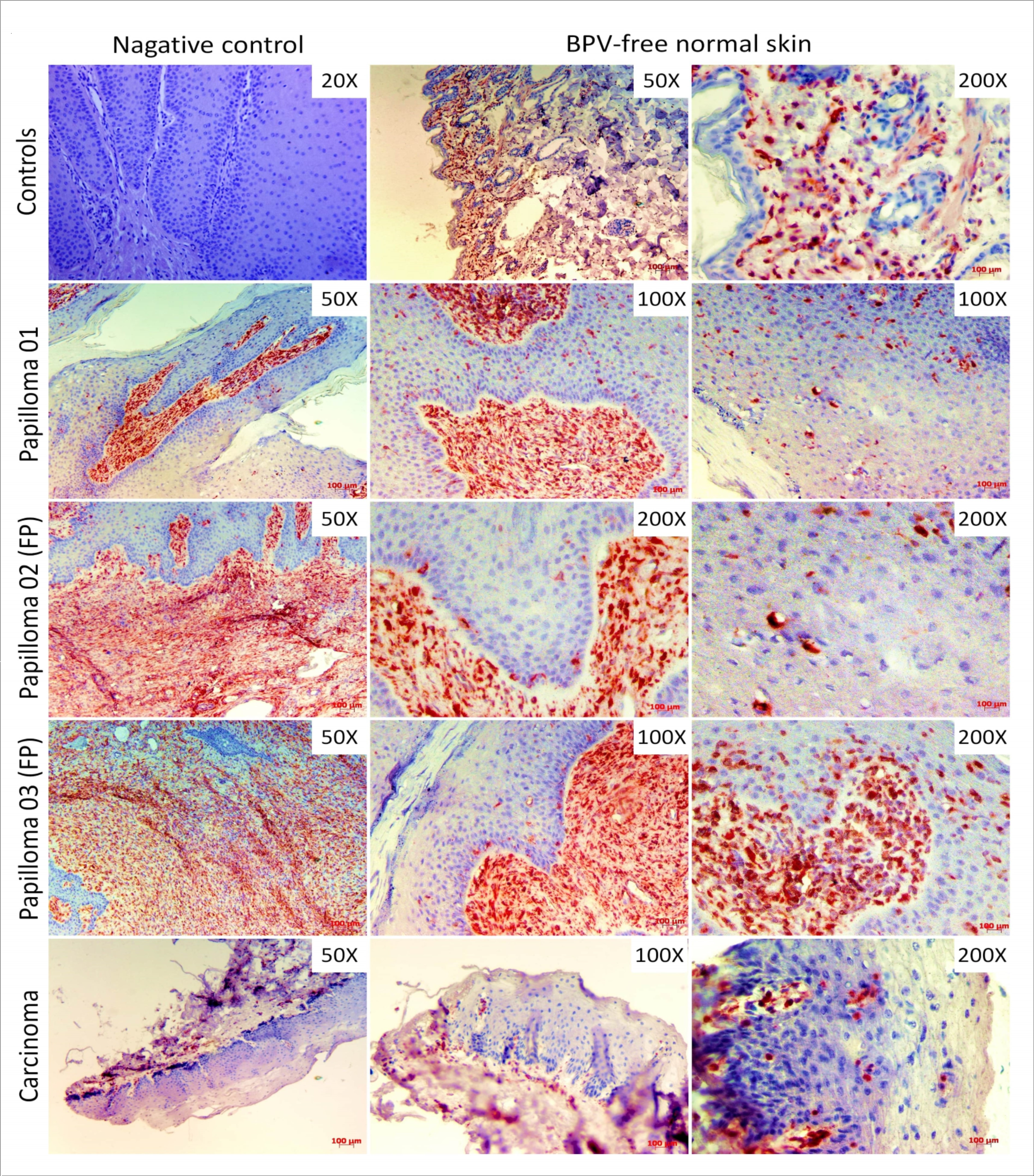 Immunodetection of vimentin showing the absence of labeling in negative control (cutaneous papilloma incubated exclusively with secondary antibody) and the protein expression into the dermis of BPV-free normal skin, but not in the epithelium. Results show the vimentin immunodetection in both dermis, as expected, and  epidermis of all BPV-infected lesions, including esophageal carcinoma. It is verified the vimentin expression in koilocytes and fibroblastoid keratinocytes present in dermoepidermal junction and suprabasal layer.