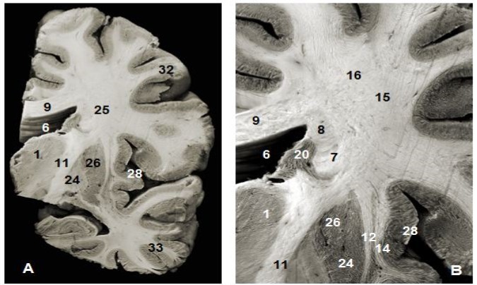 (A) Coronal view of the left hemisphere and (B) global view after magnification and before dissection of (A). 1. Thalamus, 6. Lateral ventricule 7. Subependymal substratum, 9. Corpus callosum, 11. Internal capsule, 12. External capsule, 13. Claustrum, 14. Extreme capsule, 16. Upper branch of the SLF , 20. Head of caudeus nucleus, 23. Putamen, 24. Globus pallidus, 25. Lower branch of SLF 28. Insula, 30. Corona radiata, 32. Parietal pole, 33. Temporal pole.