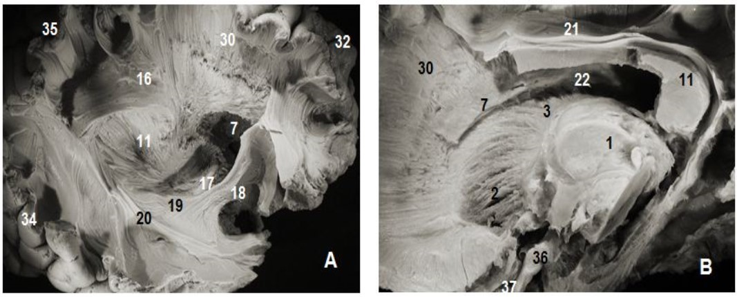 Subependymal stratum: (A) lateral view of right hemisphere and (B) medial view of left hemisphere. 1.Thalamus, 2. Anterior thalamic radiation, 7.  Subependymal substratum, 4. Ependymal membrane, 6. Lateral ventricle, 11. Splenium of corpus callosum, 21. Cingulum, 30. Corona radiata, 32. Parietal pole, 33. Frontal pole, 35. Occipital pole, 36 tract optic