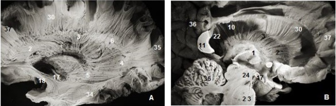 Thalamic radiations: (A) lateral view and (B) medial view. 1. Thalamus, 2. Anterior thalamic radiations, 3. Superior thalamic radiations, 4. Posterior thalamic radiations, 5. Inferior thalamic radiations, 6. Ventricular landmark, 10. Tapetum of corpus callosum, 11. Splenium of corpus callosum,  22. Ependymal membrane, 23 .Pons , 24. Mesencephalon, 17. Optic tract,  18. Uncinate fasciculus, 31. Occipital pole, 36. Cerebellum, 37.Frontal pole.