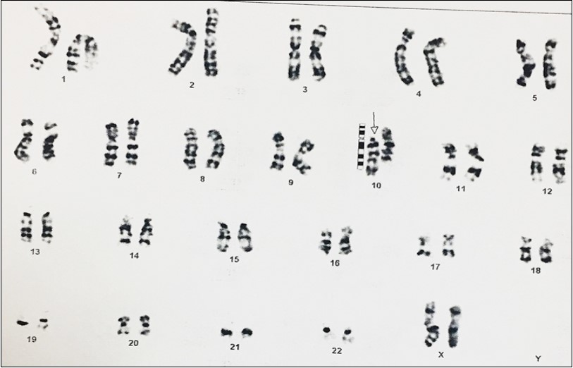 Karyotype of 46, XX, inv (10)(p11, q26) in the girl. (G banding)