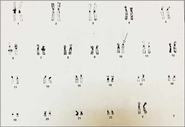 Karyotype of 46,XX, inv (10)(p11, q26) in the mother. (C banding)