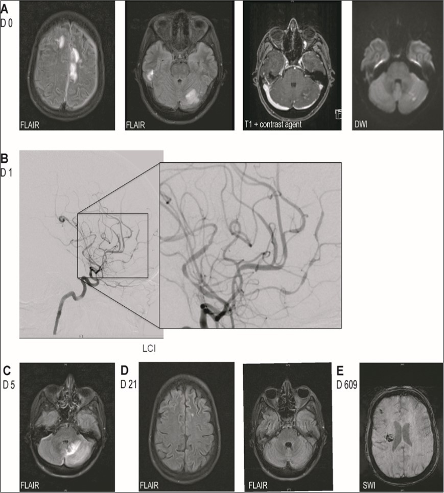 Imaging findings. (A) MRI-images on admission showing multiple supra- and infratentorial FLAIR-hyperintense lesions involving both cortex and white matter and one cerebellar lesion with weak contrast enhancement and partial DWI-hyperintensity. (B) Digital subtraction angiography showing segmental narrowing and dilation of proximal as well as distal vessels in all territories. (C) MRI-images 4 days after start of steroid-therapy showing progression of the FLAIR-hyperintense lesion. (D) MRI images after administration of methylprednisolone and cyclophosphamide showing nearly full regression of parenchymal lesions. (E) MRI shortly before the patient's death showing blood degradation products in the right frontal subarachnoid space and right basal ganglia.