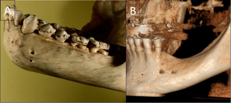 A general view of a gorilla mandible with a vertical double foramen (A) and a human mandible with a horizontal double foramen (B).
