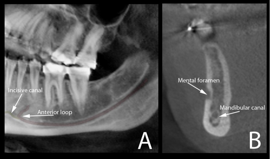 Cone beam CT image (A) shows the oblique reconstruction of the volume of interest at the region of premolars. In this reconstruction, the anterior loop of the mandibular canal can be clearly observed before the start of the incisive canal. The appearance of this anterior loop in a cross-sectional view is shown in image (B).