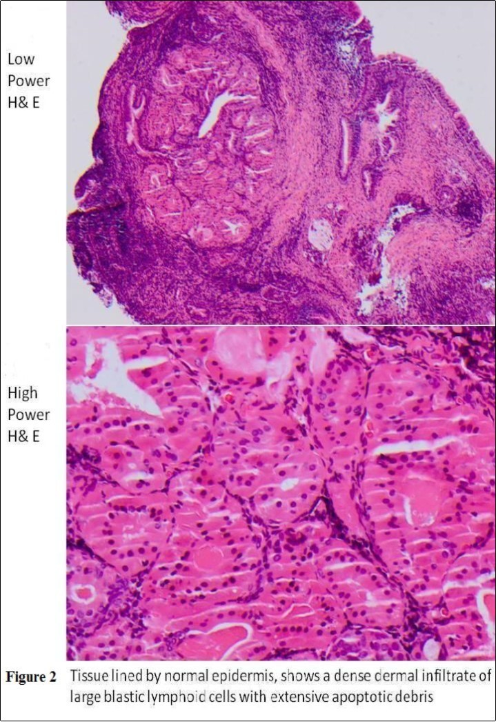Low/High Power H & E: Dermal infiltrate of large blastic lymphoid cells