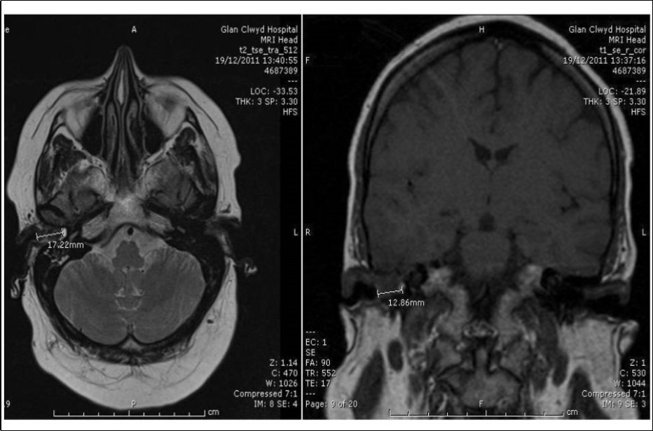 Axial MRI head showing extension from medial aspect of right EAC intracranially